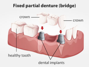 3D image of how a dental bridge work with implants for  a more permanent solution.